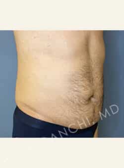 Tummy Tuck