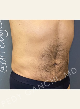 Tummy Tuck