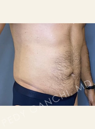 Tummy Tuck