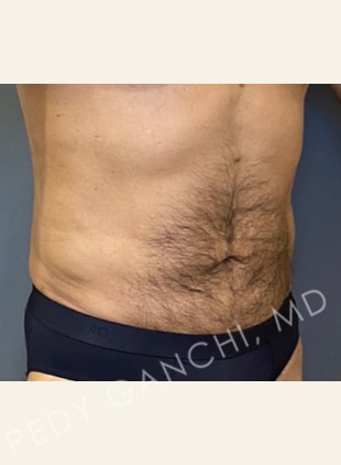 Tummy Tuck