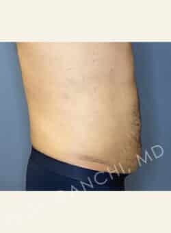 Tummy Tuck