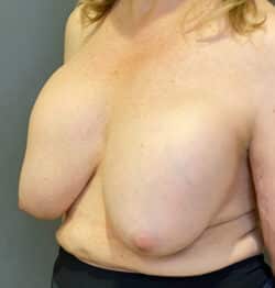 Breast Implant Revision (Explant)