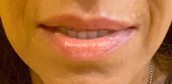 Lip Augmentation