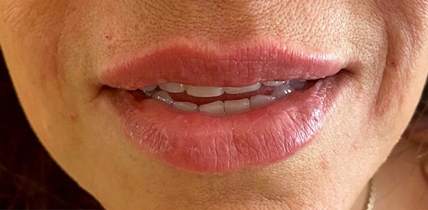 Lip Augmentation