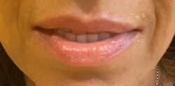 Lip Augmentation