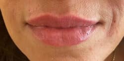 Lip Augmentation