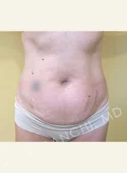 Tummy Tuck