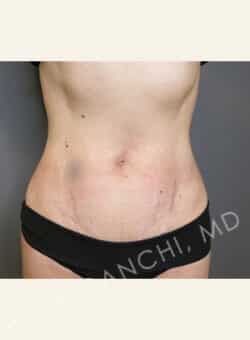 Tummy Tuck