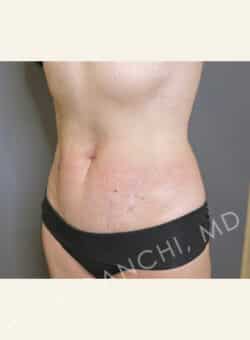 Tummy Tuck