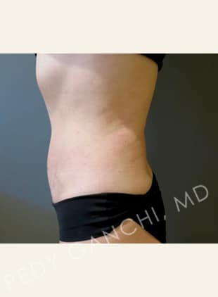 Tummy Tuck