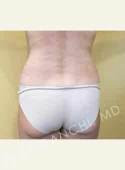 Tummy Tuck