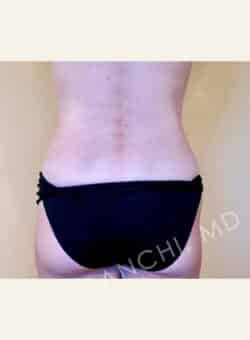 Tummy Tuck