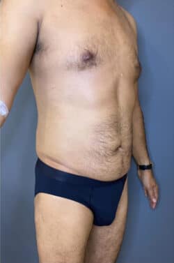 Liposuction