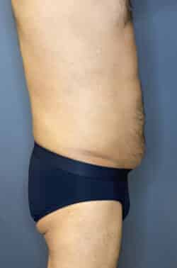 Liposuction