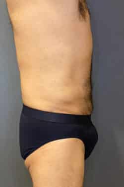 Liposuction