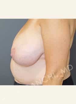 Breast Reduction (female)