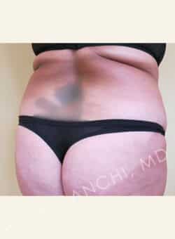 Tummy Tuck