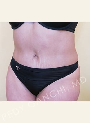 Tummy Tuck