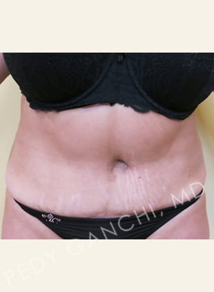 Tummy Tuck