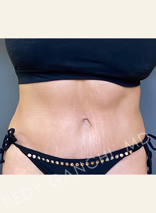 Tummy Tuck