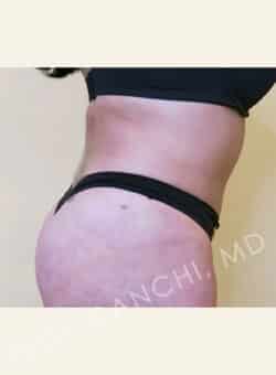 Tummy Tuck