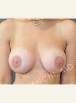 Breast Augment with Lift