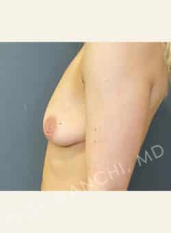 Breast Augment with Lift