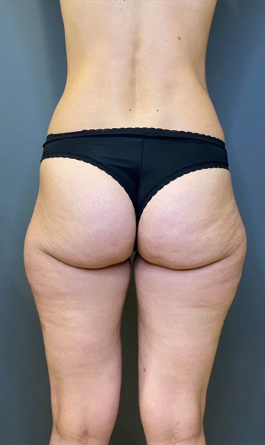 Liposuction