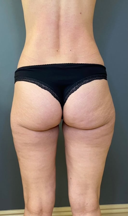 Liposuction