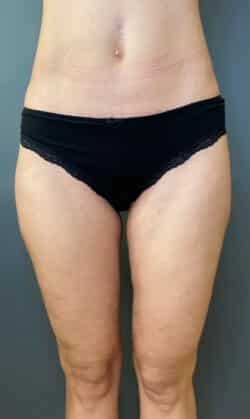 Liposuction