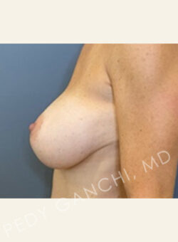 Breast Augment with Lift
