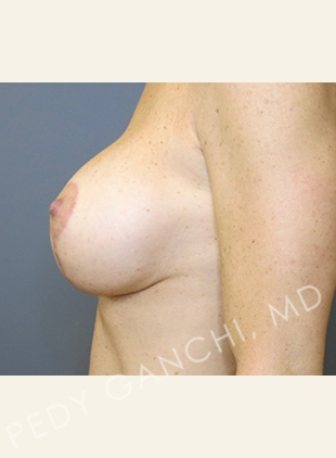 Breast Augment with Lift