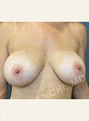 Breast Augment with Lift