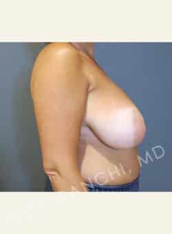 Breast Reduction (female)