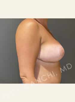 Breast Reduction (female)