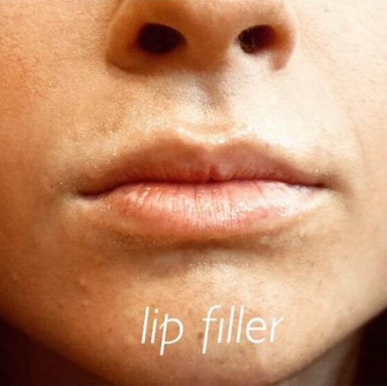 Lip Augmentation