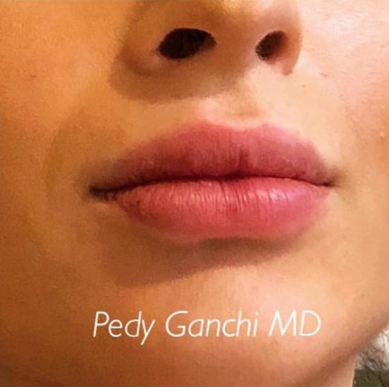 Lip Augmentation