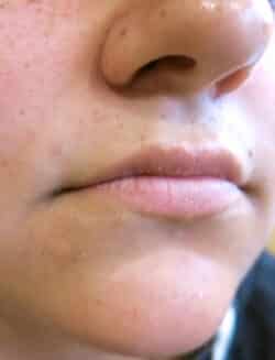 Lip Augmentation