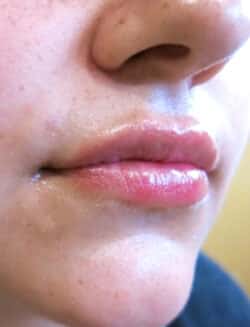 Lip Augmentation