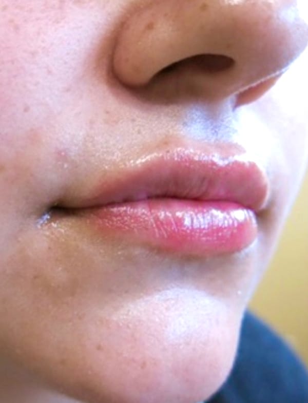 Lip Augmentation