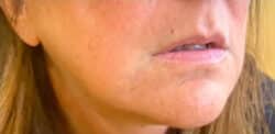 Lip Augmentation