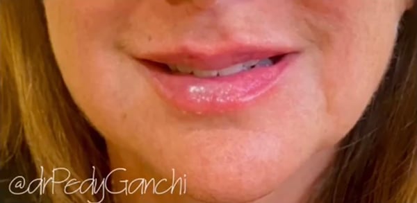 Lip Augmentation