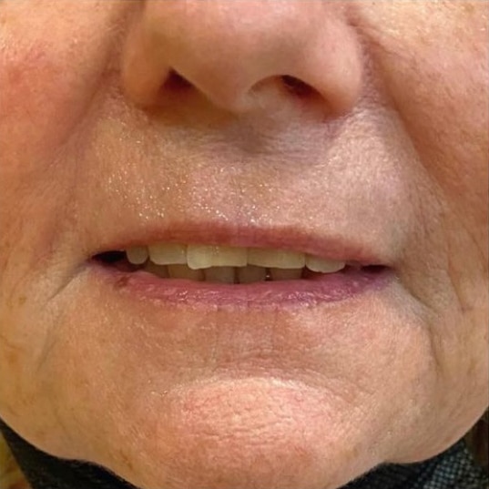 Lip Augmentation