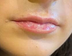 Lip Augmentation