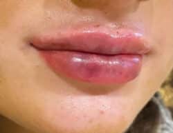 Lip Augmentation