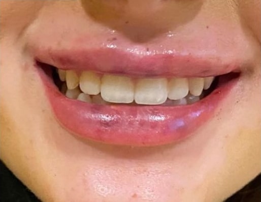 Lip Augmentation