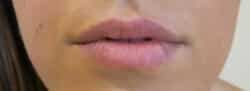 Lip Augmentation