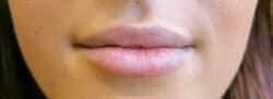 Lip Augmentation