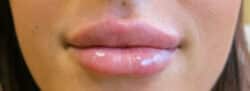 Lip Augmentation