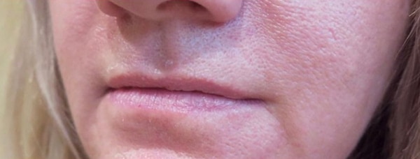 Lip Augmentation